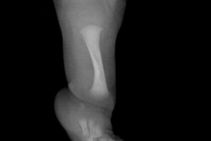 Un nene con una rara enfermedad fue operado para desarrollar un hueso fundamental | FM Avenida