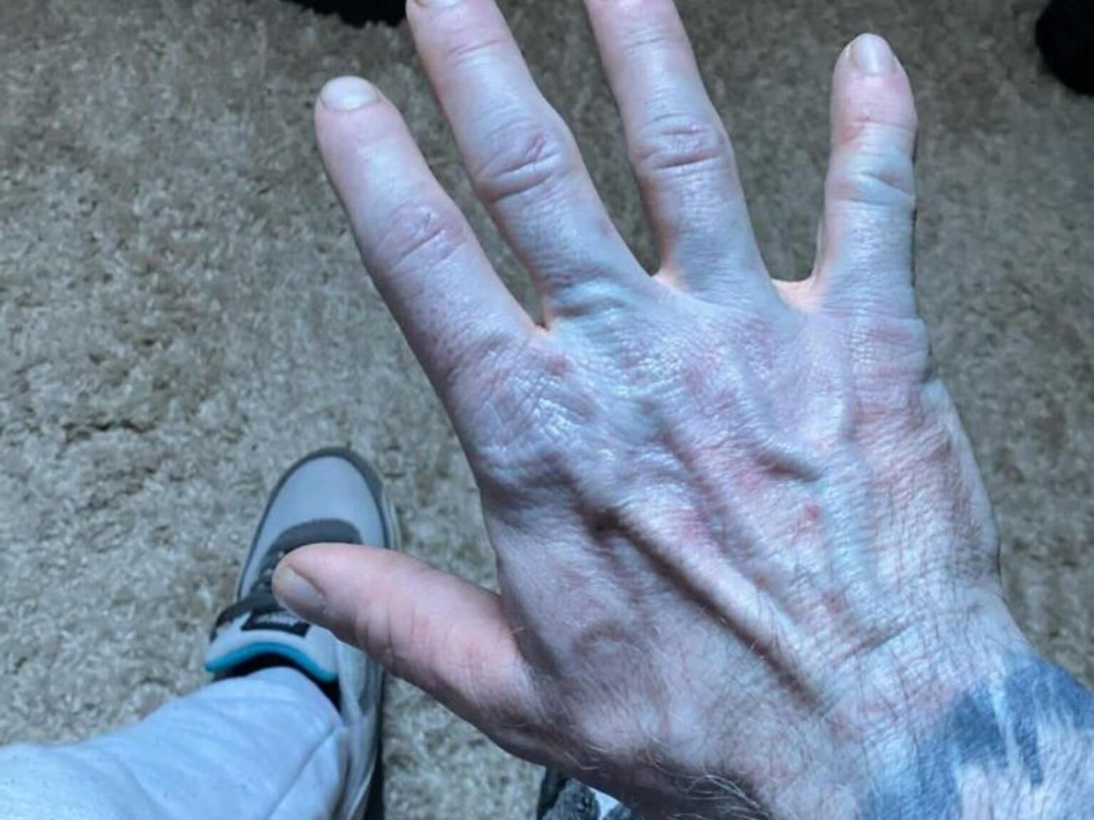 Se despertó con la piel azul y en el hospital descubrió la inesperada causa: "Me sentí avergonzado" | FM Avenida