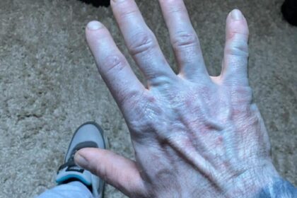 Se despertó con la piel azul y en el hospital descubrió la inesperada causa: "Me sentí avergonzado" | FM Avenida