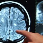 Alerta por un hongo que infecta el cerebro y tiene 70% de tasa de mortalidad: se cuadruplicaron los casos y los científicos no saben por qué | FM Avenida