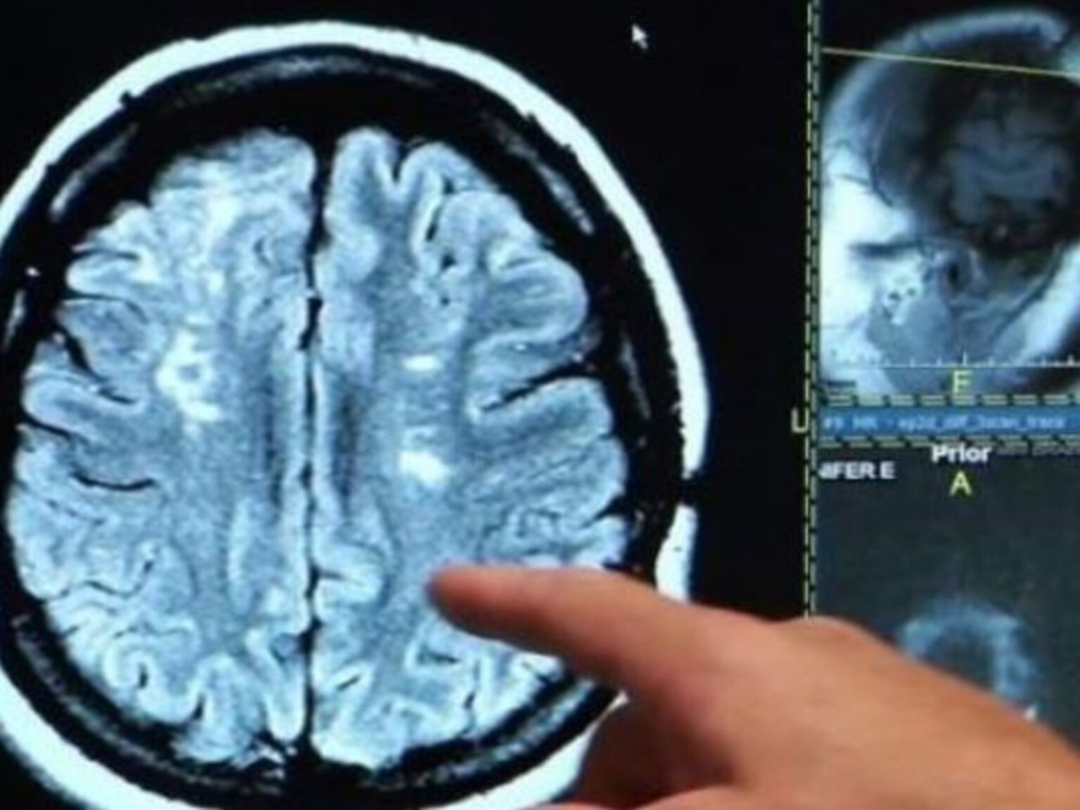 Alerta por un hongo que infecta el cerebro y tiene 70% de tasa de mortalidad: se cuadruplicaron los casos y los científicos no saben por qué | FM Avenida