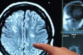 Alerta por un hongo que infecta el cerebro y tiene 70% de tasa de mortalidad: se cuadruplicaron los casos y los científicos no saben por qué | FM Avenida