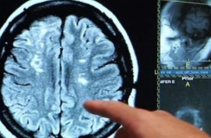 Alerta por un hongo que infecta el cerebro y tiene 70% de tasa de mortalidad: se cuadruplicaron los casos y los científicos no saben por qué | FM Avenida